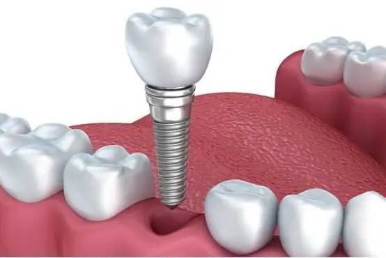 凯发k8官方登录牙齿美白种植牙的五大危害全口种植牙有什么风险或后遗症？
