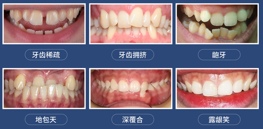 凯时网站牙齿有缝修复多少钱牙齿修复牙齿矫正费用一览表重庆大足寒假牙齿矫正每月只要