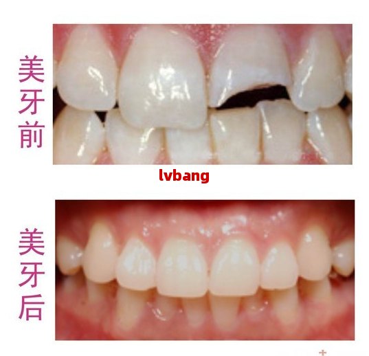 k8凯发种植牙种后后悔死了牙齿修复牙齿白斑修复多少钱牙齿伤残鉴定标准及赔偿202