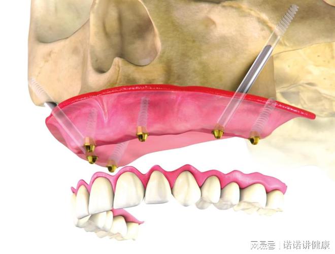 k8凯发牙齿修复种植牙齿要多久做全口即刻种植需要多长时间？刘体亮科普