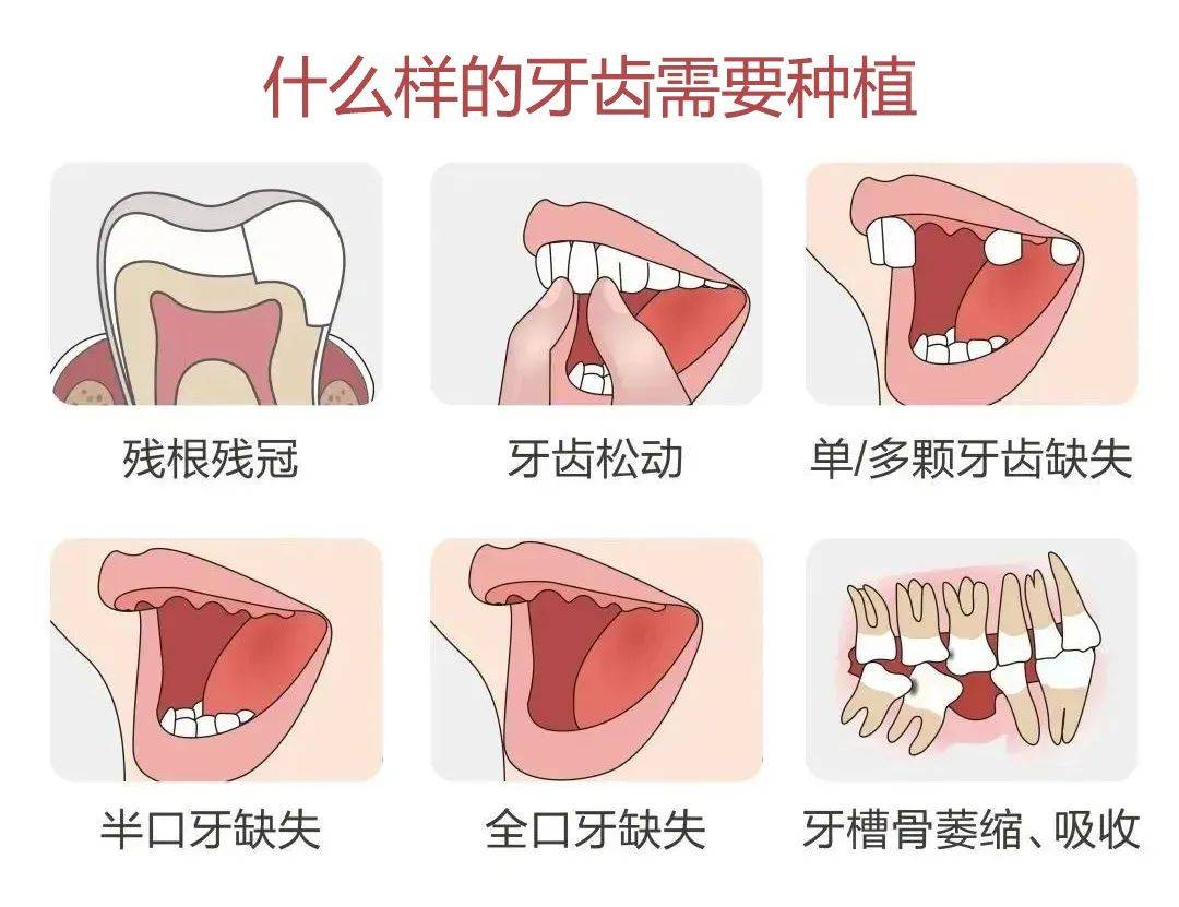 k8凯发为什么人都后悔洗牙牙齿修复牙齿缺失修复价格@广西人恭喜缺牙、牙不齐、牙疼