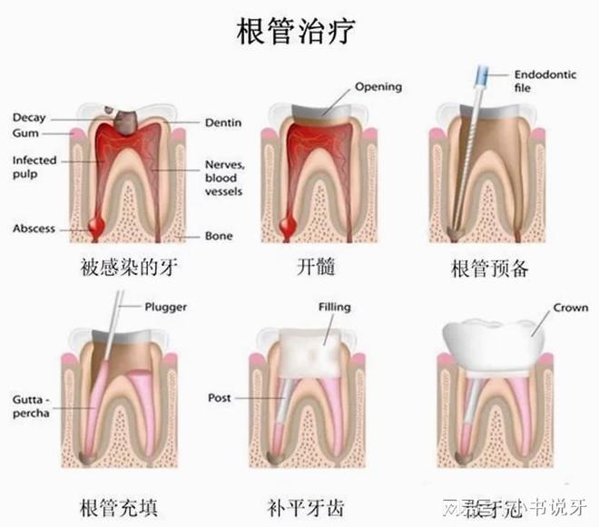 k8凯发牙齿修复牙齿裂成两半怎么办根管不做冠早晚是后患！患者“不做冠”后牙齿劈成