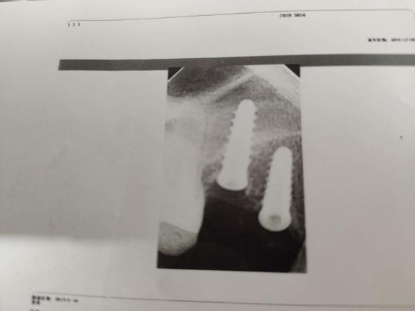 k8凯发种植牙新技术牙齿修复种牙后后悔死了私人诊所种牙坑人牵出“植是道”上千万走