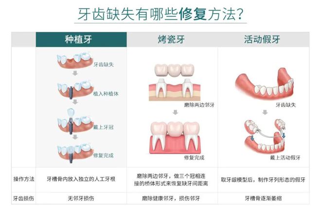 k8凯发掉牙也传染？牙齿成排掉怎么办？医生建议及时种植修复稳固牙槽骨