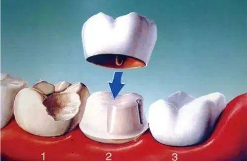 k8凯发牙齿修复需要做牙冠吗？多少人不懂就“死”在这一条