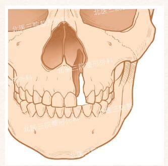 k8凯发官网，【唇裂鼻畸形】牙槽脊裂修复